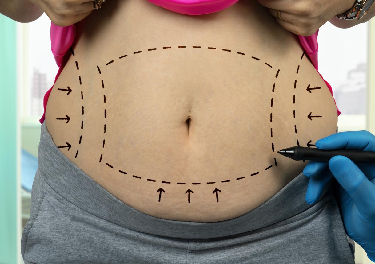 abdominoplastia